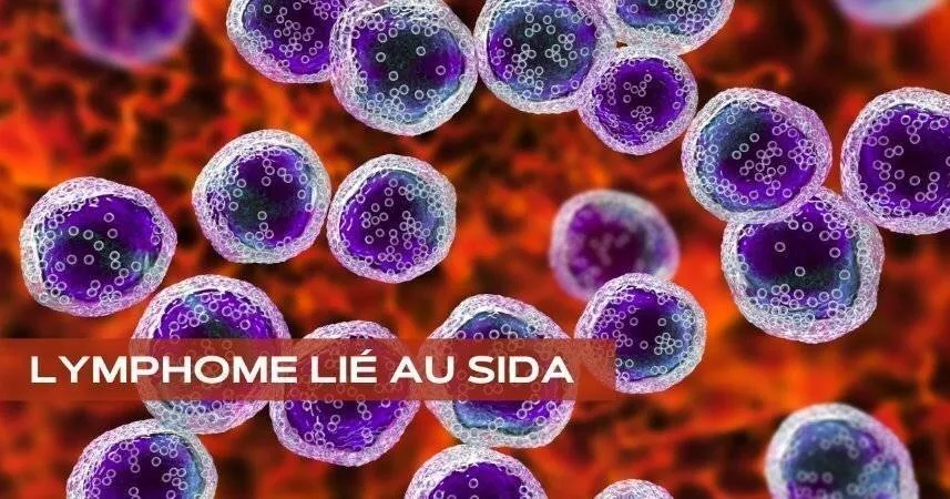 Lymphome lié au SIDA