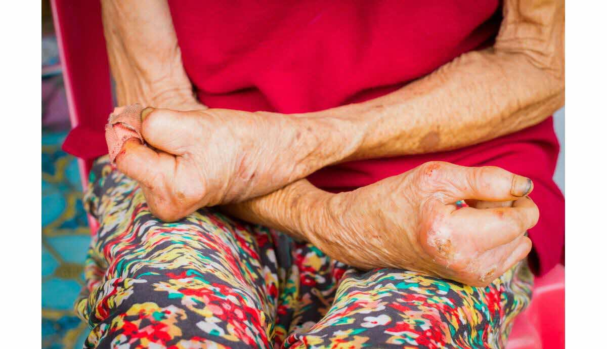 Cas de lèpre détectés dans un spa à Cluj