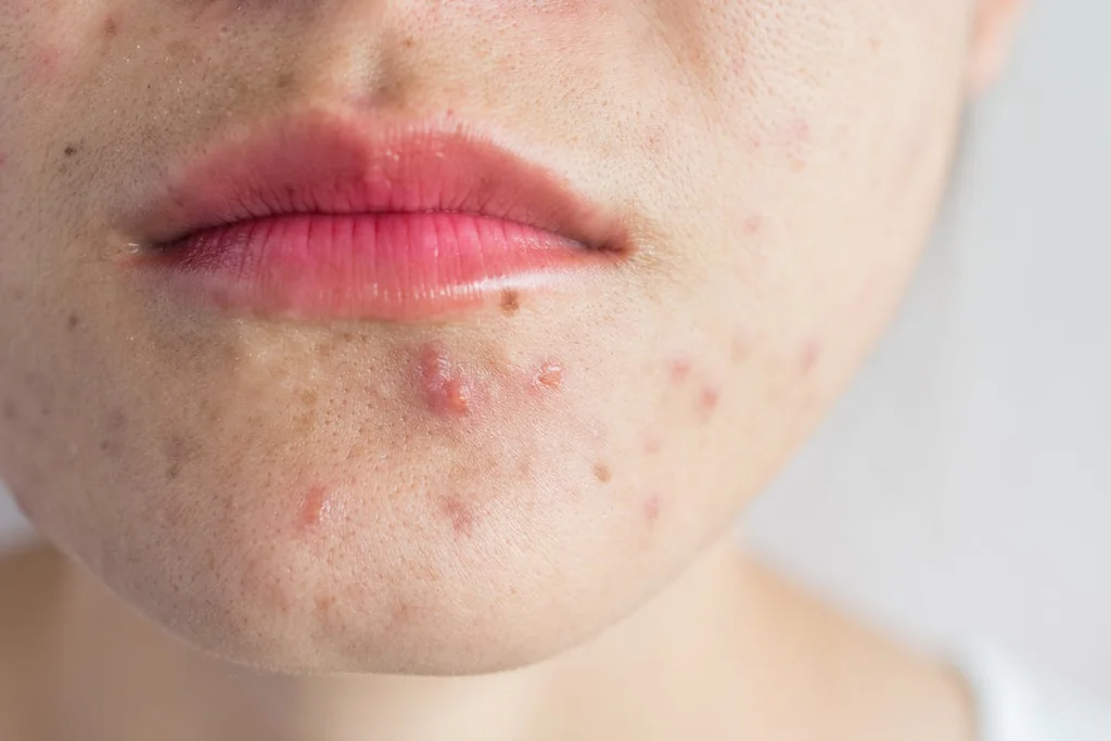 Papules : Faut-il percer, ignorer ou traiter ?