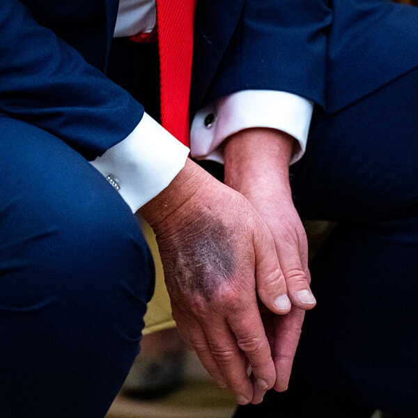 Trump main droite avec ecchymoses et explication