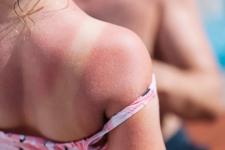 Burn lines : Une tendance TikTok dangereuse pour la santé