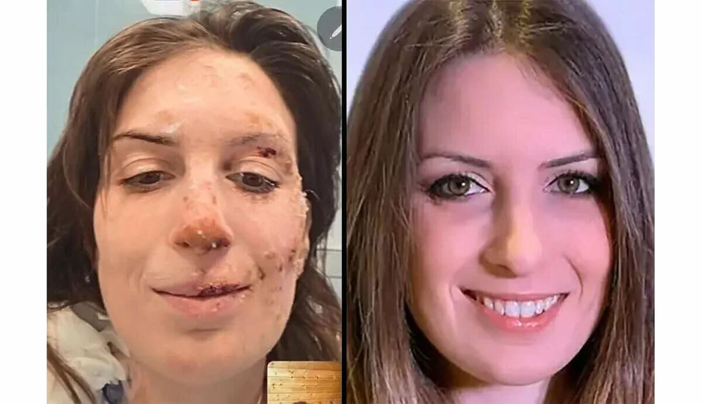 Crans-Montana: rescapée italienne publie des images de son visage brûlé