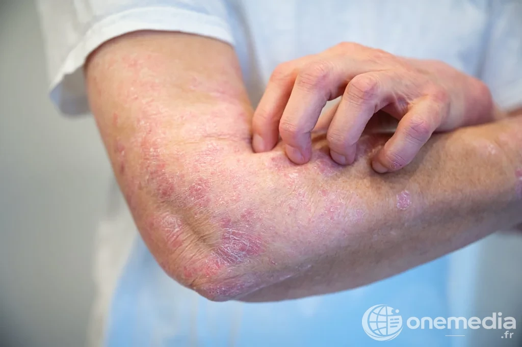 Psoriasis : 70 % des patients touchés par des maladies associées